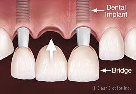 Dental Implants